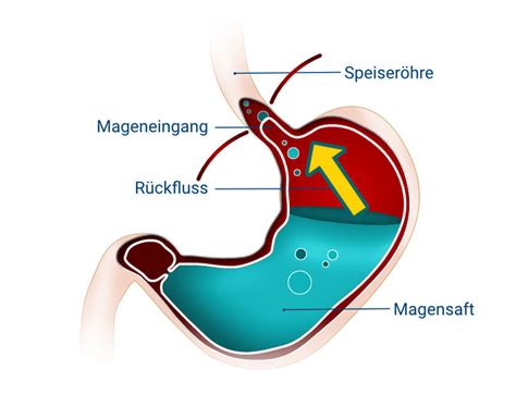 sodbrennen in der speiseröhre