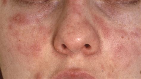 soleksem ansikte bilder