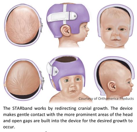 some helmet/cranial band questions — The Bump