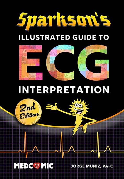 sparkson s illustrated guide to ecg interpretation