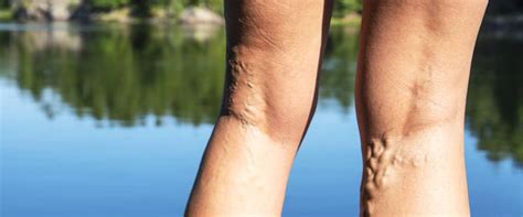 spataderen symptomen