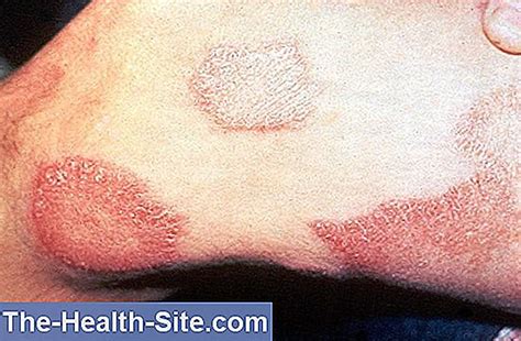 spetälska behandling