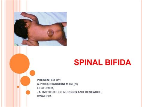 Spina Bifida Slideshare