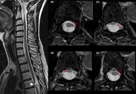Spinal Arachnoid Cysts In Adults  Diagnosis And Management  A Single Center Experience In  Journal Of Neurosurgery  Spine Volume 29 Issue 6  2018  Journals - Suspect Adalah