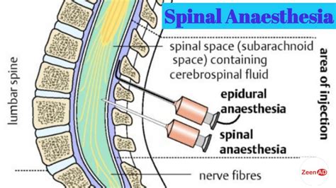 Spinal Cord Anesthesia