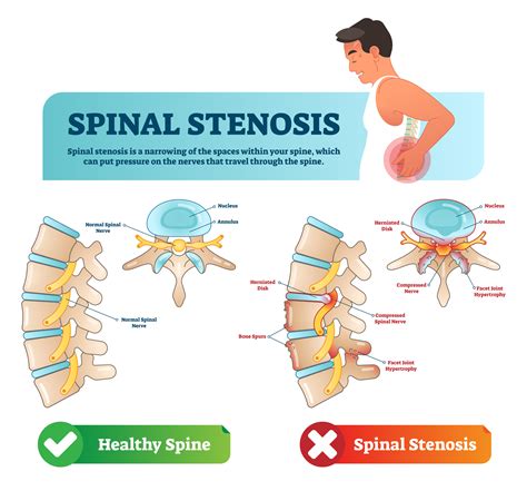 spinal stenosis 뜻