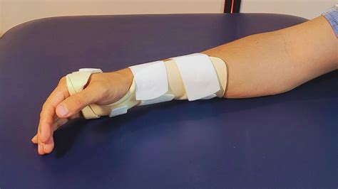 Splinting The Hand And Upper Extremity Principles And Process