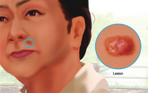 spridd basalcellscancer