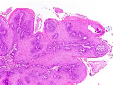 Squamous Cell Papilloma