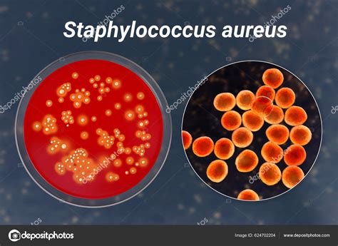 stafilococcus aureus