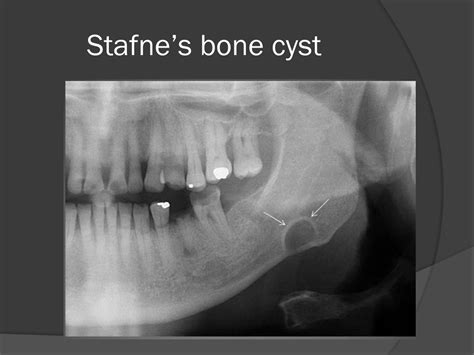 Stafne Bone Cyst