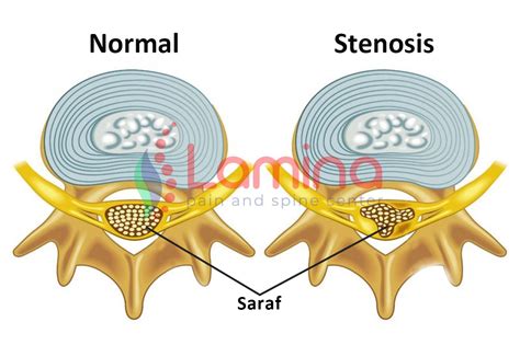 stenosis adalah
