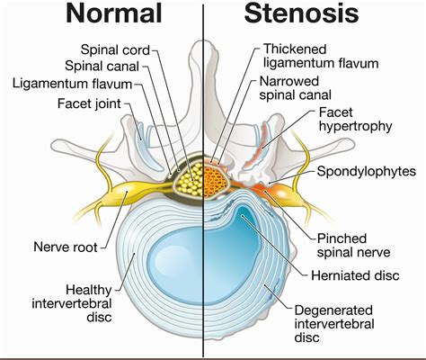 Stenosis Opposite