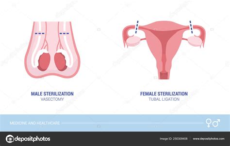 sterilisering man pris