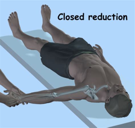 Read Sternum Dislocation Manual Guide 