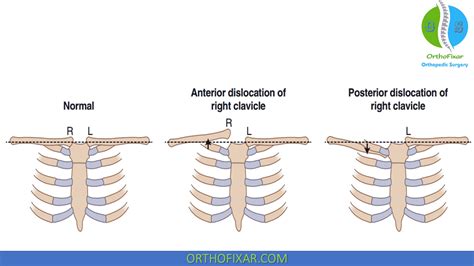 Read Sternum Dislocation Manual Guide 