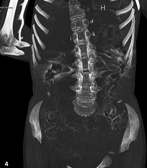 Stone Mans Disease