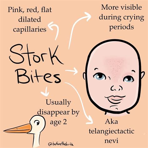 stork kiss medical term