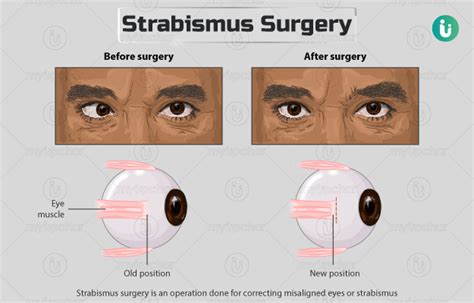 Strabismus Surgery Cost