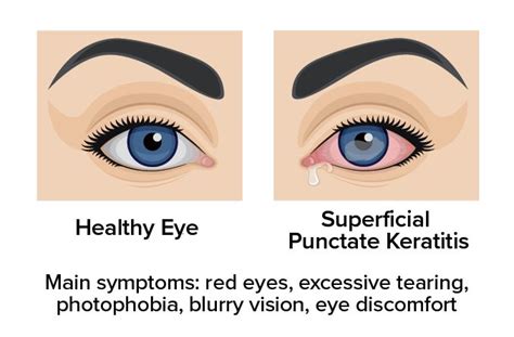Superficial Punctate Keratitis