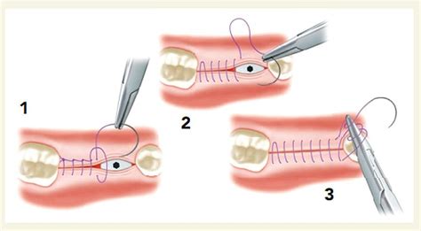 Read Online Suturing Techniques In Oral Surgery 