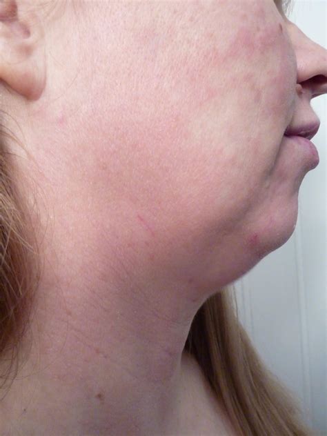 svamp efter antibiotika