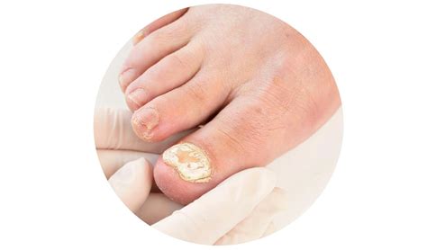 svamp under nageln behandling