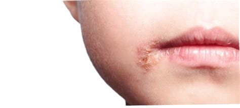 svinkoppor husmorstips