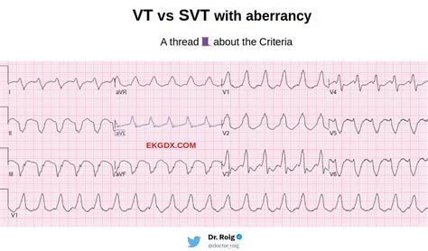 Svt Vs Vt