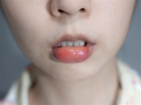 swollen bottom lip overnight - dlinnovations.com