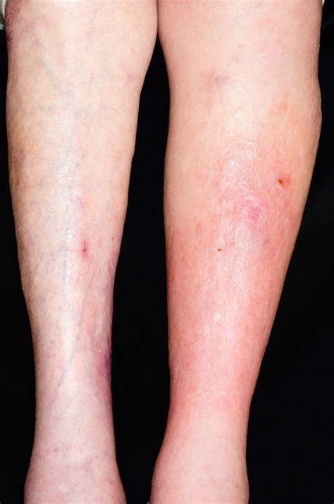 symptom blodpropp