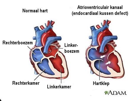 symptomen hartgeruis
