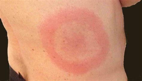 symtom borrelia små barn