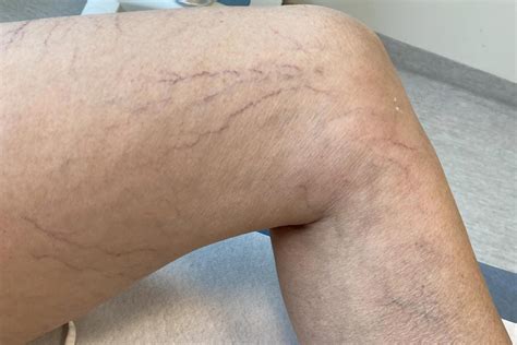 synliga ådror armarna