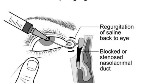 Syringing Of Eye