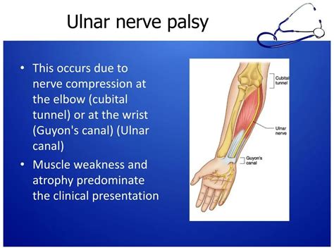 Tardy Ulnar Nerve Palsy