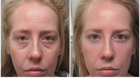 tear trough svullnad