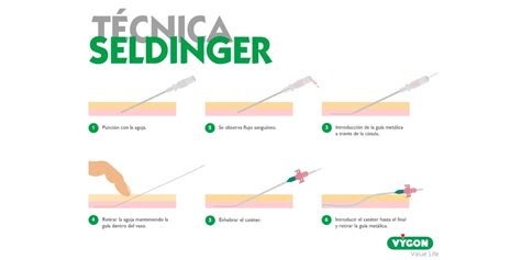 Tecnica De Seldinger