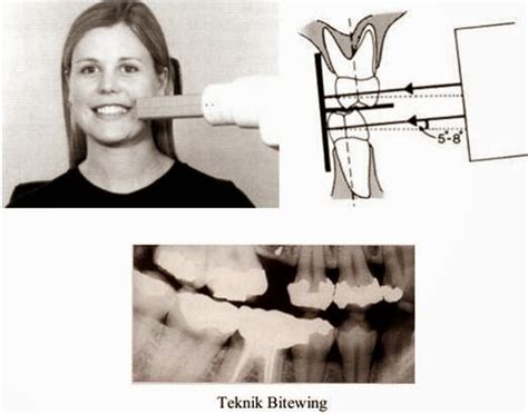 teknik radiografi intraoral pdf