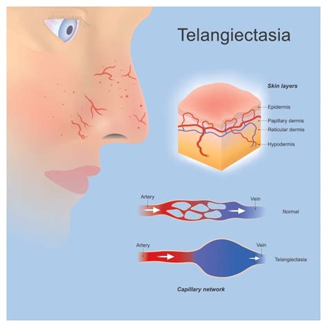 Telangiectasia Hepatica Que Es
