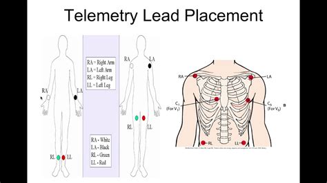 Telemetry Lead Placement