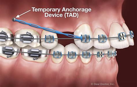 Temporary Anchorage Device