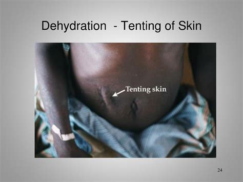 Tenting Of Skin