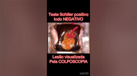 Teste De Schiller Iodo Positivo