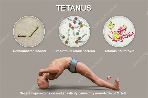 Tetanus