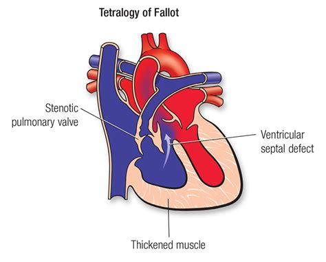 Tetralogy Of Fallot Ppt