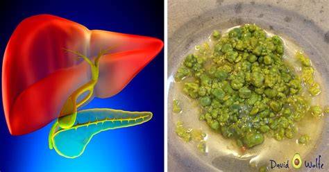 the amazing liver gallbladder flush