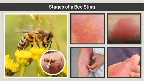 The Bee Sting Summary