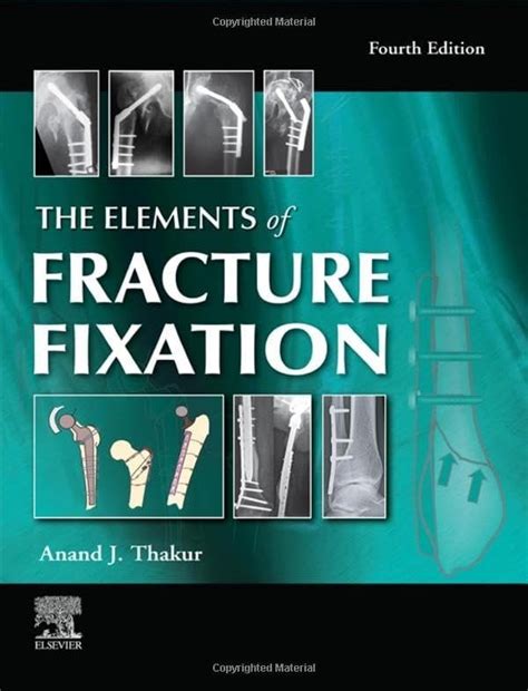 The Elements Of Fracture Fixation