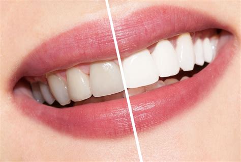 The Science Of Teeth Whitening Secrets To A White Science Teeth Whitening - White Science Teeth Whitening